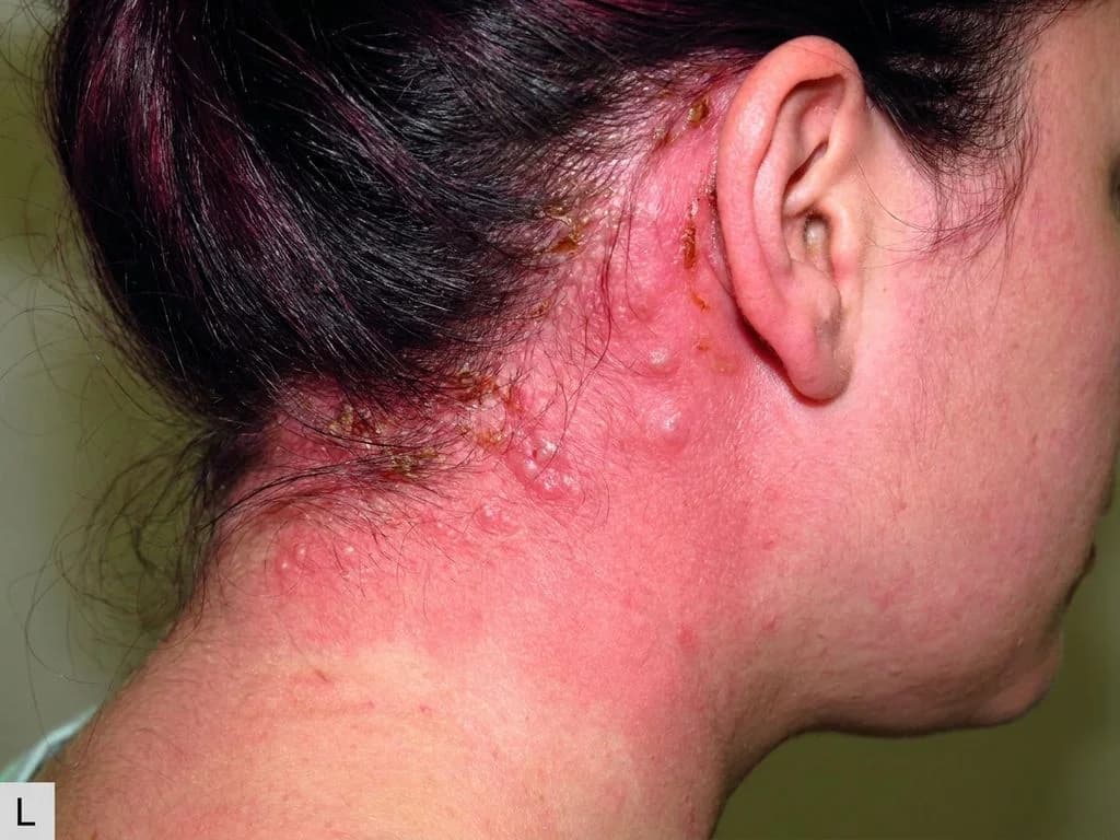 Clinical image for NEET PG 2023 Q48