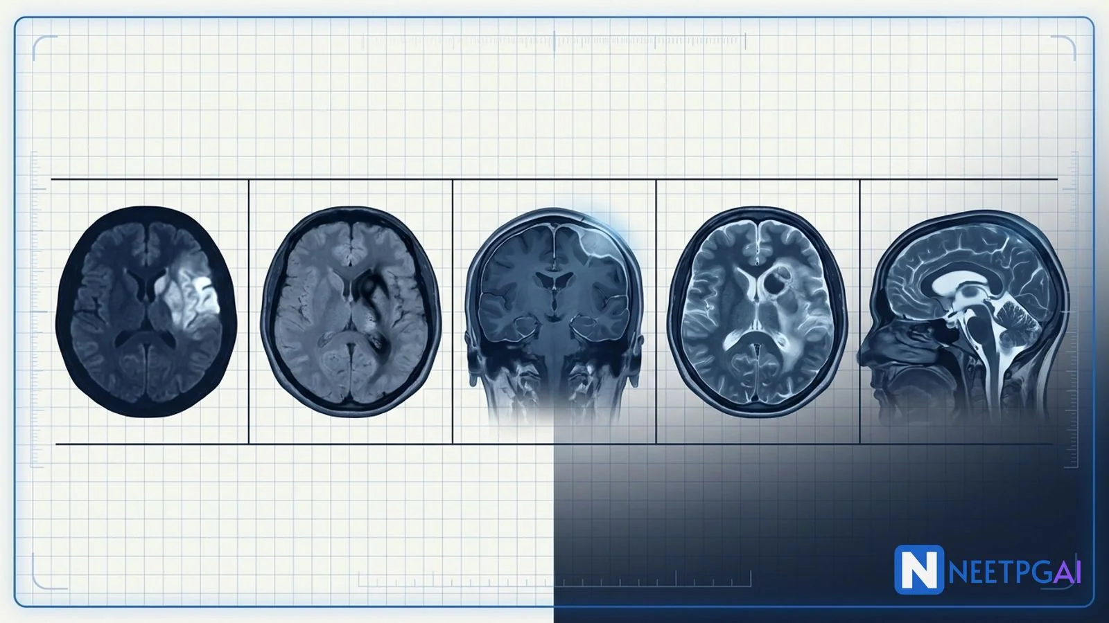 Image MCQ: MRI Brain Emergencies for NEET PG (Stroke, ICH, Meningioma, GBM vs Metastases, Hydrocephalus)