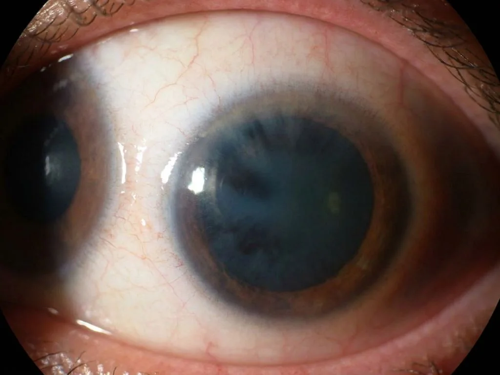 Clinical image for NEET PG 2022 Q51