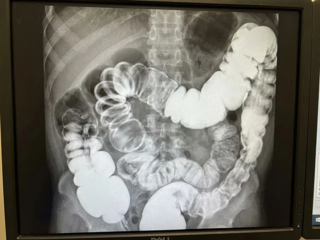 Clinical image for NEET PG 2022 Q108