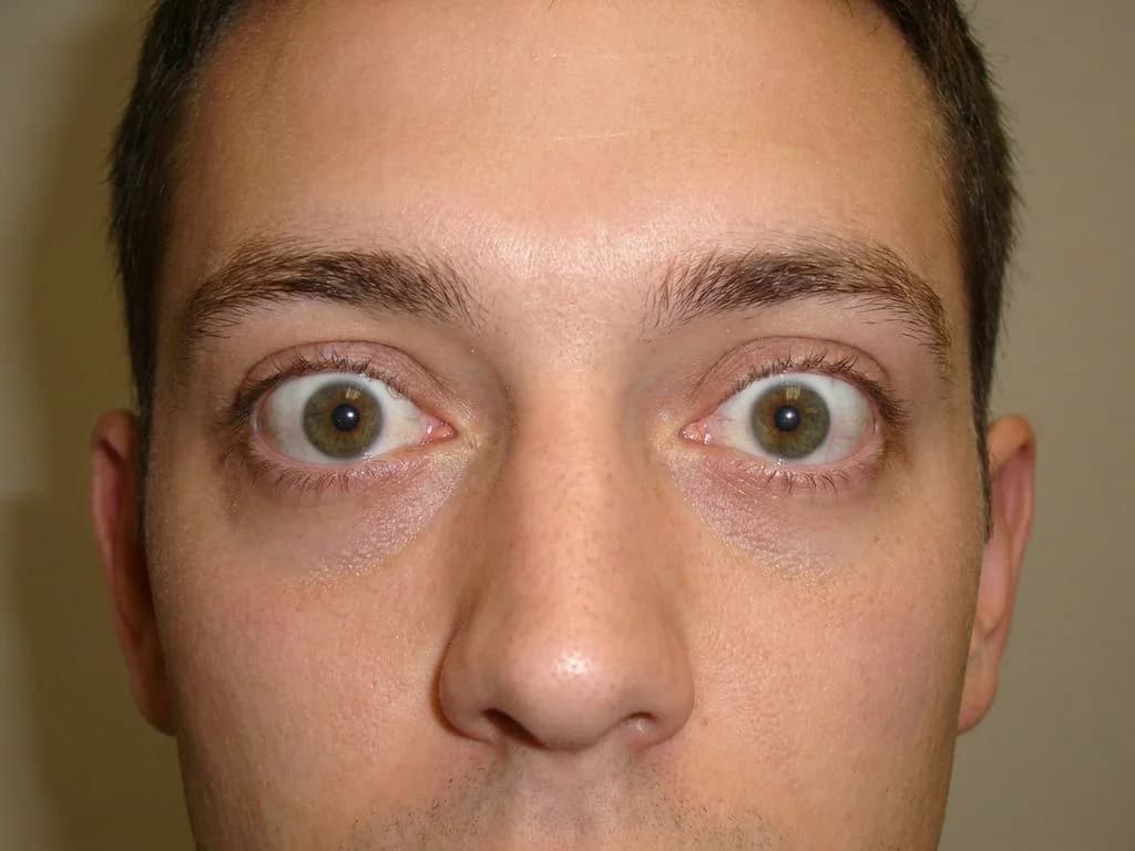 Clinical image for NEET PG 2023 Q102
