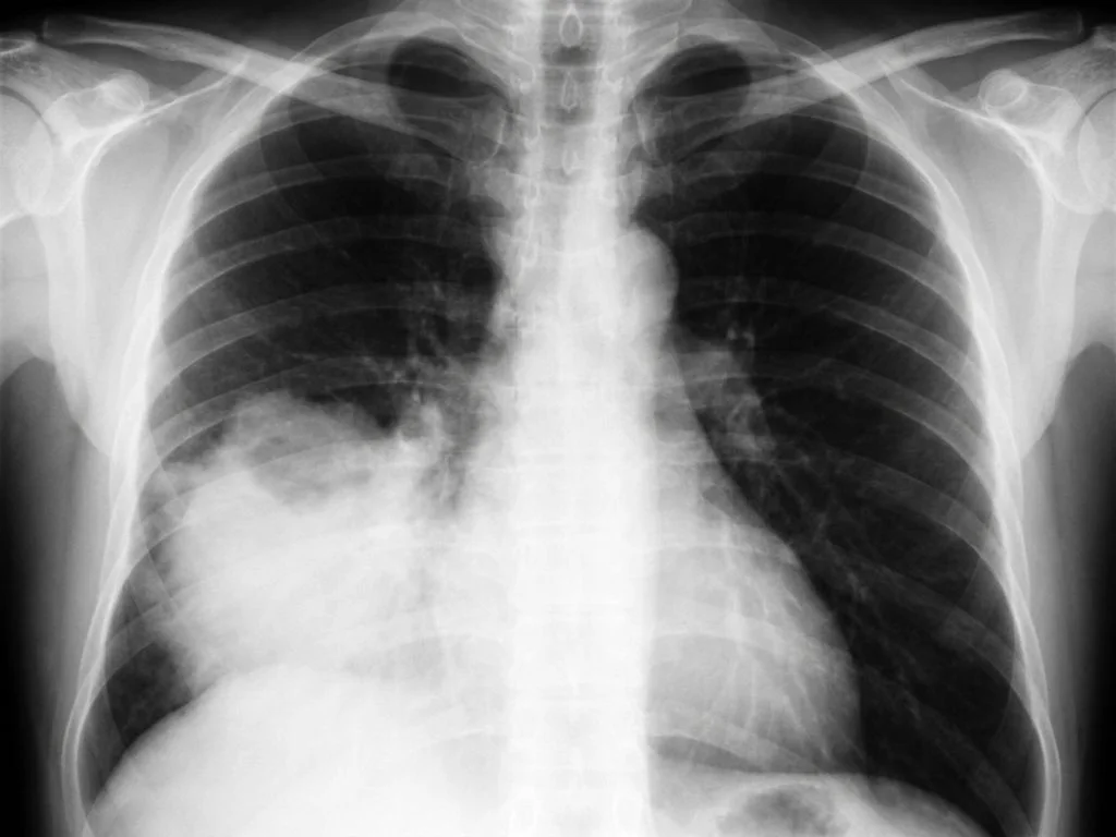 Clinical image for NEET PG 2023 Q167