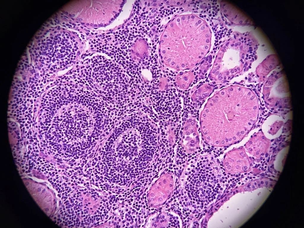 Clinical image for NEET PG 2018 Q78