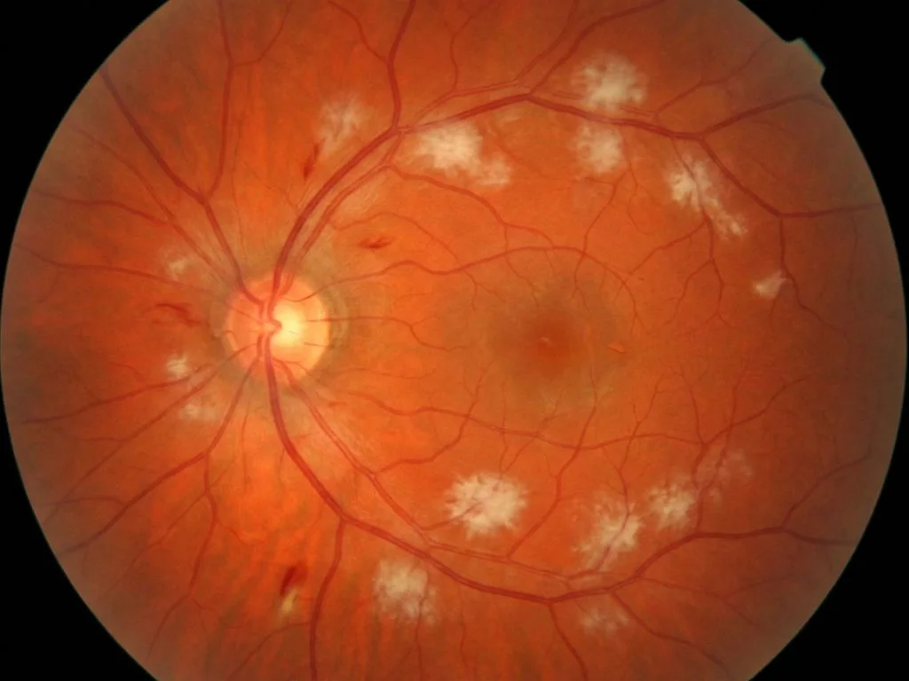 Clinical image for NEET PG 2021 Q180