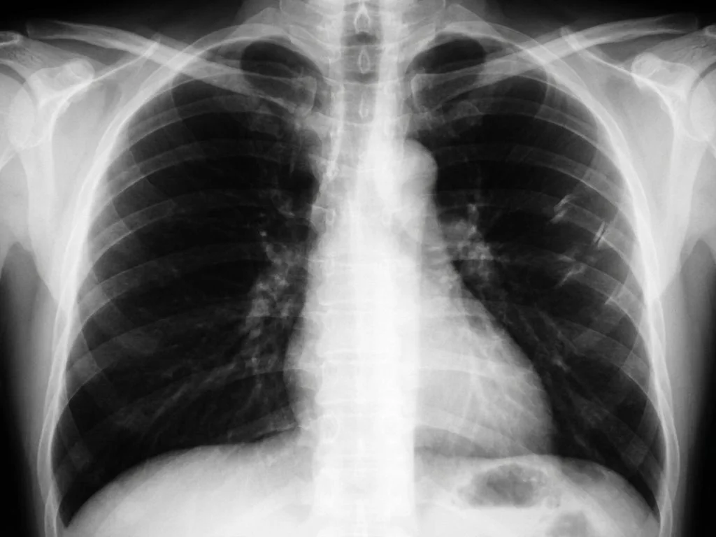 Clinical image for NEET PG 2022 Q138