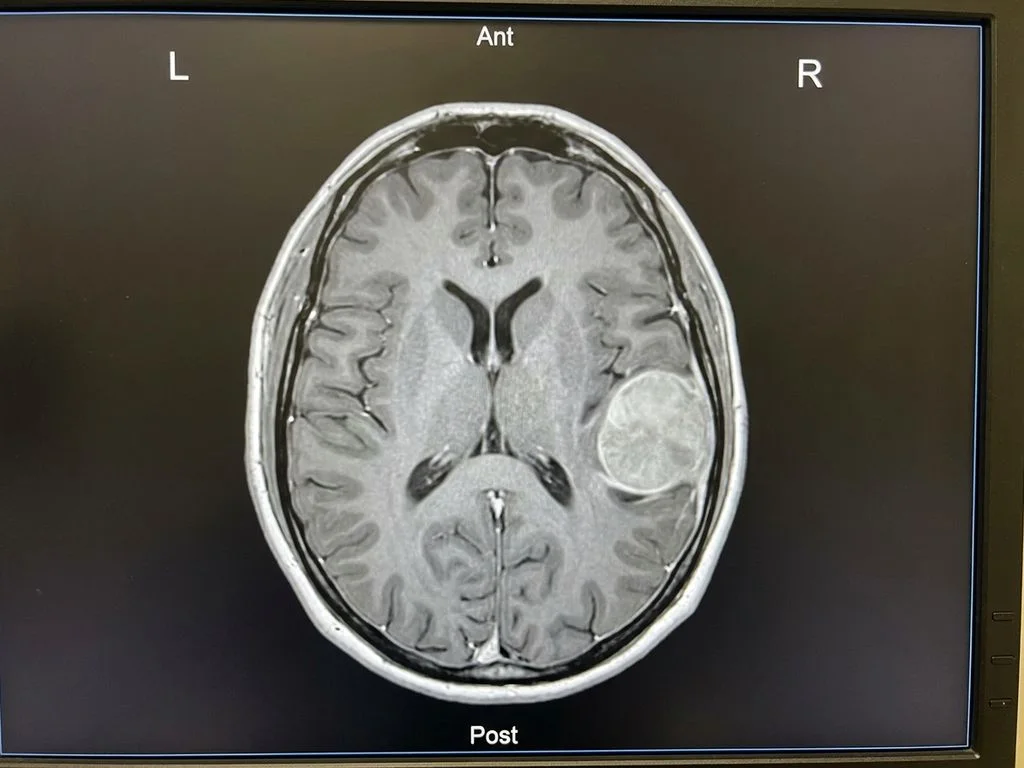 Clinical image for NEET PG 2025 Q185